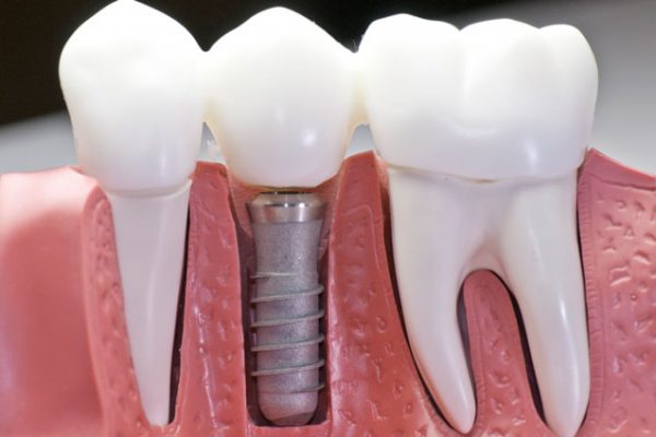 implantes dentales málaga