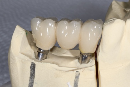 implantes dentales en Málaga