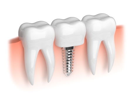 colocación implantes dentales Málaga