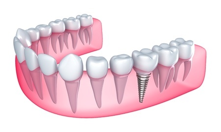 implante dental Málaga
