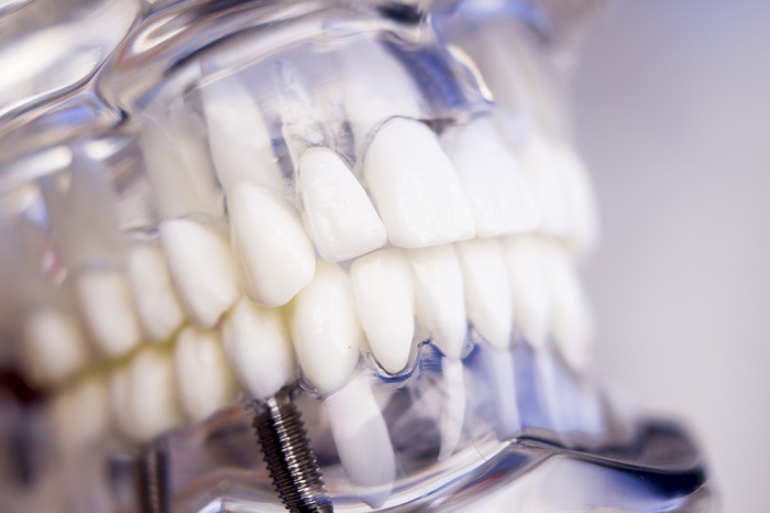 implantes dentales de calidad en Málaga